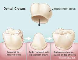 Dental Crowns - Robin F. Wood, DDS & Associates